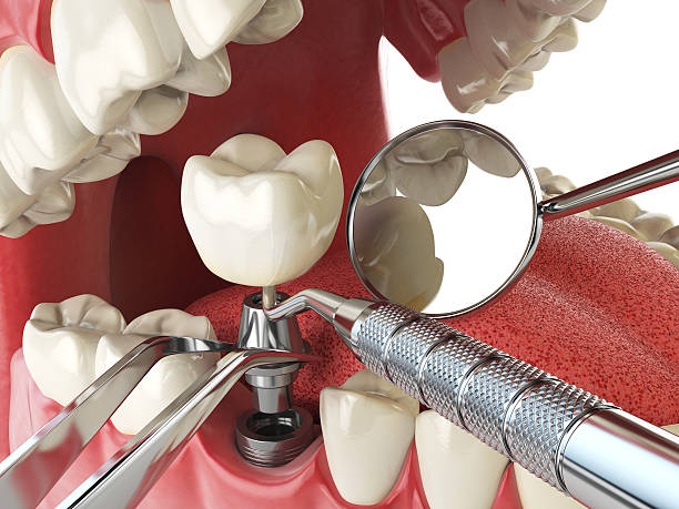 Best Emergency Treatment for Dental Infections or Abscesses in Laporte, CO